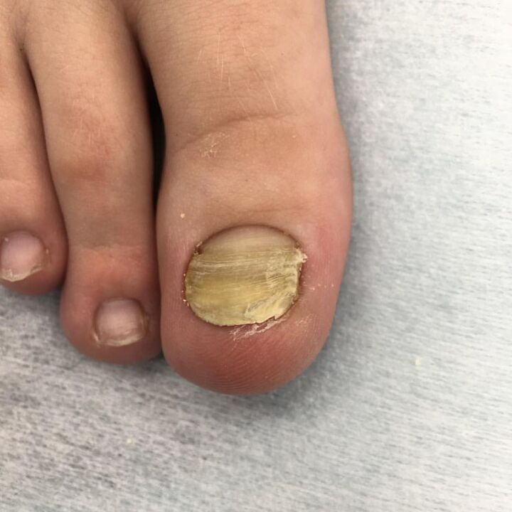 Infection des champignons