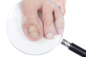 Causes de champignons à ongles
