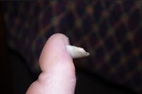 Symptômes des champignons sur les ongles