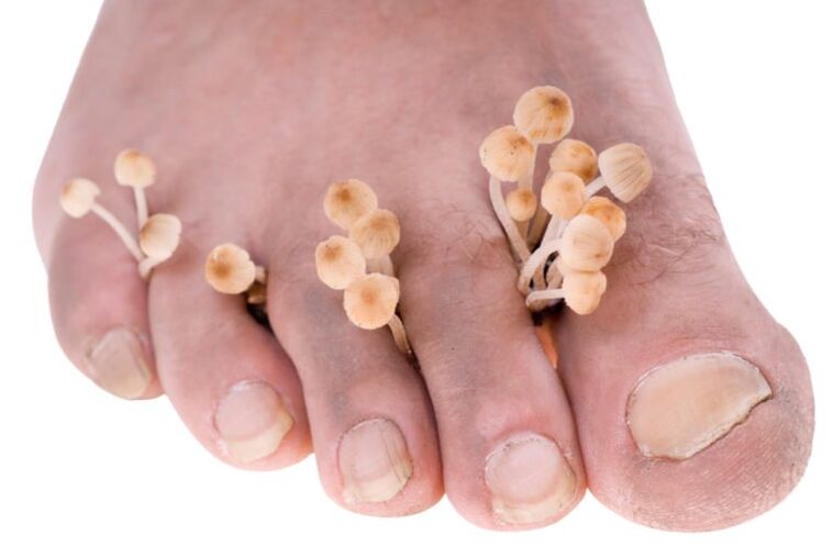 Mushroom sur les symptômes des jambes