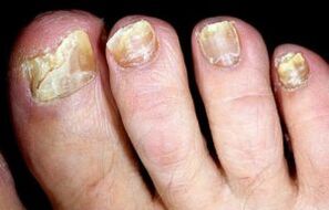 symptômes de mycose des ongles des pieds